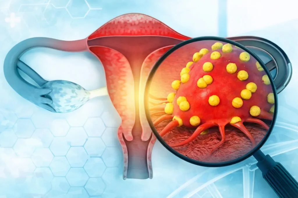Ilustración profesional sobre cáncer cervicouterino mostrando el virus del VPH en el cuello uterino