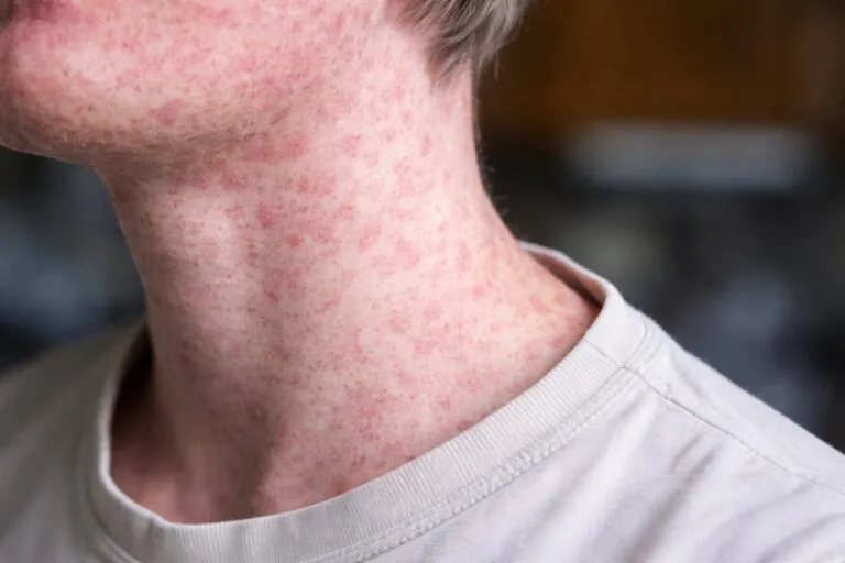 Estudiantes universitarios en Florida reciben vacunación contra sarampión en jornada gratuita de salud pública